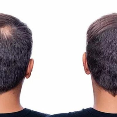 Effective Hair Growth Pills to Boost Your Hair Growth